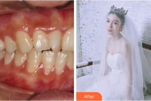 紹興京韓口腔醫(yī)院董立志整形價格表附牙齒隱形矯正案例展示