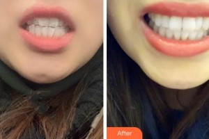 紹興京韓口腔醫(yī)院全熙鎮(zhèn)整形價格表附隱形托槽矯正案例展示