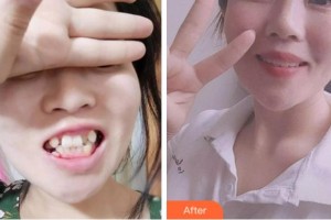 紹興京韓口腔醫(yī)院陳婷整形價格表附金屬托槽矯正案例展示