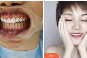 紹興京韓口腔醫(yī)院李運科整形價格表附美白貼片案例展示