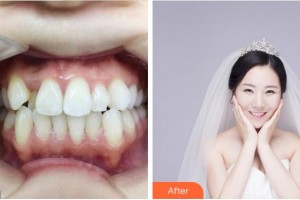 紹興柯橋口腔醫(yī)院郭曉燕整形價格表附金屬托槽矯正案例展示