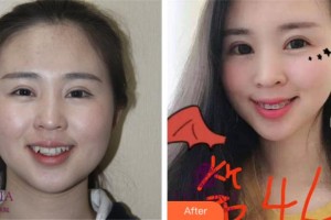 紹興柯橋口腔醫(yī)院楊學鵬整形價格表附金屬托槽矯正案例展示