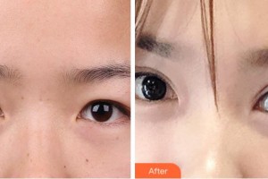 金華芘麗芙（原華美）整形醫(yī)院吳朔凡整形價格表附切開雙眼皮案例展示