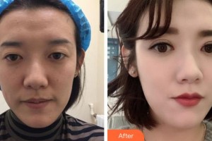 金華芘麗芙（原華美）整形醫(yī)院李信峰整形價格表附切開雙眼皮案例展示