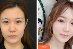 鄭州解放軍153中心醫(yī)院激光美容整形中心郭金華整形價格表附熱瑪吉案例展示