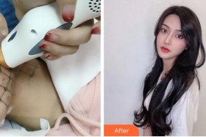 金華中心醫(yī)院整形美容中心童蕓整形價格表附熱瑪吉案例展示