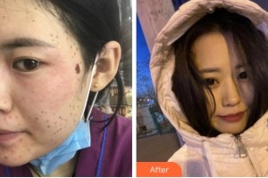 金華美辰醫(yī)療美容醫(yī)院徐伶愛整形價格表附激光美膚激光案例展示