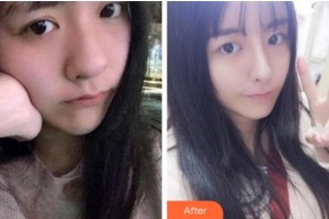 金華美辰醫(yī)療美容醫(yī)院嚴晟整形價格表附熱瑪吉案例展示