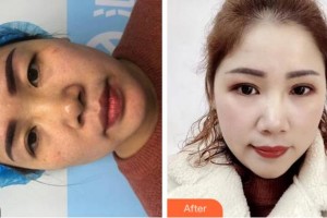 金華康美醫(yī)療美容綜合門診部孫傳整形價格表附定點雙眼皮案例展示