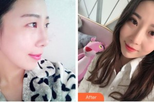 金華杭嬰整形美容外科診所朱杭嬰整形價格表附眼部綜合案例展示