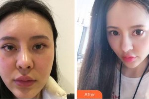金華三星(原協(xié)和)整形醫(yī)院彭愛芳整形價格表附埋線提升案例展示