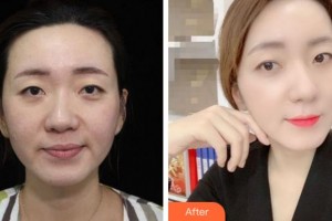 金華亞美整形美容醫(yī)院葉彩娣整形價格表附熱拉提案例展示