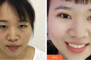 金華康美醫(yī)療美容綜合門診部劉興權(quán)整形價格表附定點雙眼皮案例展示