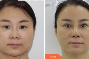 金華亞美整形美容醫(yī)院薛磊整形價(jià)格表附切開(kāi)雙眼皮案例展示