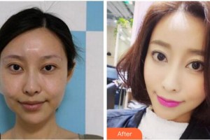 金華藝馨醫(yī)療美容門(mén)診部杜曦整形價(jià)格表附埋線提升案例展示