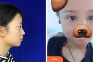 金華愛(ài)爾眼科醫(yī)院杜新華整形價(jià)格表附切開(kāi)雙眼皮案例展示