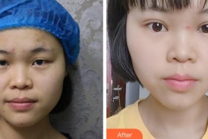 金華愛(ài)爾眼科醫(yī)院孫忠海整形價(jià)格表附切開(kāi)雙眼皮案例展示