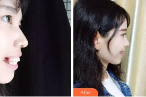 金華周亞軍口腔門(mén)診部周亞軍整形價(jià)格表附隱形托槽矯正案例展示