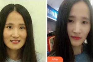 金華婁城口腔醫(yī)院彭濤整形價(jià)格表附牙齒陶瓷矯正案例展示