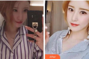 金華市人民醫(yī)院整形美容中心蔡陽(yáng)群整形價(jià)格表附祛眼袋案例展示