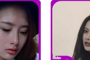 金華市人民醫(yī)院整形美容中心胡維君整形價(jià)格表附切開(kāi)雙眼皮案例展示