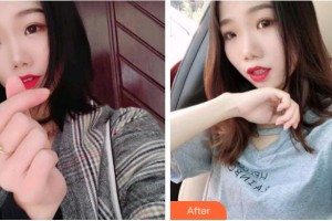 金華周亞軍口腔門診部何兆浦整形價(jià)格表附牙齒隱形矯正案例展示