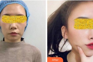 衢州美萊整形美容醫(yī)院謝磊整形價(jià)格表附除皺案例展示