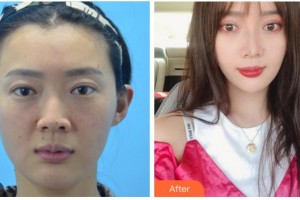 衢州美萊整形美容醫(yī)院陳愛云整形價(jià)格表附埋線提升案例展示