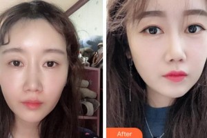 衢州市人民醫(yī)院整形美容科王秋明整形價(jià)格表附熱瑪吉案例展示