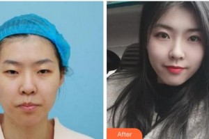 衢州芘麗芙整形美容醫(yī)院祝小平整形價(jià)格表附眼部綜合案例展示