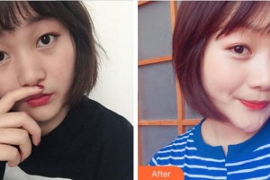 衢州芘麗芙整形美容醫(yī)院邢恒鋒整形價(jià)格表附熱拉提案例展示