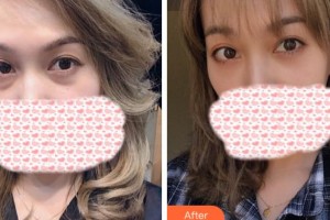 衢州美萊整形美容醫(yī)院王新杰整形價(jià)格表附內(nèi)切祛眼袋案例展示