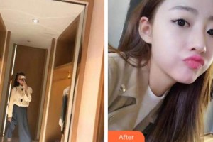 衢州芘麗芙整形美容醫(yī)院陳佑媛整形價(jià)格表附牙齒隱形矯正案例展示