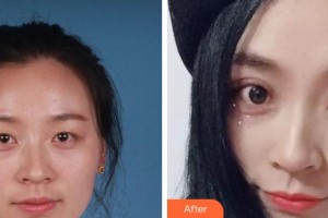 衢州芘麗芙整形美容醫(yī)院李威整形價(jià)格表附切開雙眼案例展示