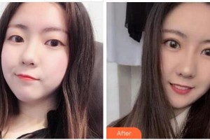 衢州愛(ài)爾眼科醫(yī)院張民軍整形價(jià)格表附切開(kāi)雙眼皮案例展示