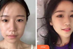 衢州愛(ài)爾眼科醫(yī)院周武英整形價(jià)格表附眼部整形案例展示