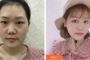 衢州愛(ài)爾眼科醫(yī)院麻張偉整形價(jià)格表附眼部綜合案例展示