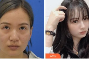 衢州愛(ài)爾眼科醫(yī)院李衛(wèi)整形價(jià)格表附激光去眼袋案例展示