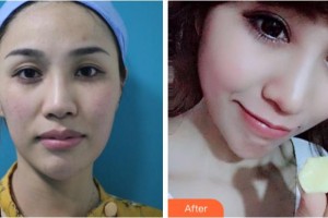 衢州市第二人民醫(yī)院眼科王慧琴整形價(jià)格表附眼部綜合案例展示