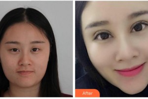 衢州市第二人民醫(yī)院眼科藍(lán)建文整形價(jià)格表附眼部綜合案例展示