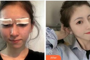 衢州市第二人民醫(yī)院眼科符建云整形價(jià)格表附切開(kāi)雙眼皮案例展示