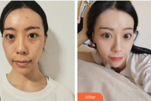 舟山新城劉靜醫(yī)療美容診所劉靜整形價(jià)格表附埋線提升案例展示