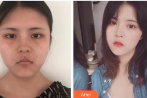 舟山港東醫(yī)療醫(yī)療美容診所季愛(ài)琴整形價(jià)格表附埋線提升案例展示