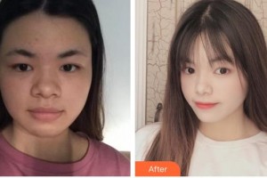 舟山普陀區(qū)人民醫(yī)院整形外科錢定國(guó)整形價(jià)格表附埋線提升案例展示