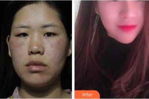 臺(tái)州博雅美惠醫(yī)療美容整形醫(yī)院占潔整形價(jià)格表附鼻部綜合案例展示