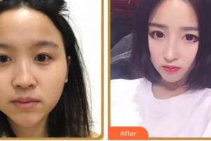 臺(tái)州市博愛(ài)醫(yī)院整形美容科唐毅整形價(jià)格表附鼻部綜合案例展示