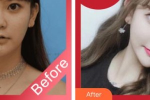 臺州市博愛醫(yī)院整形美容科方芳整形價格表附鼻部綜合案例展示