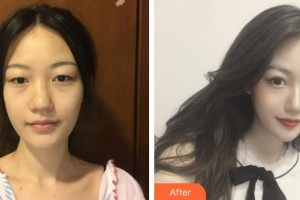 臺州廣濟整形美容醫(yī)院逯聯合整形價格表附鼻部綜合案例展示