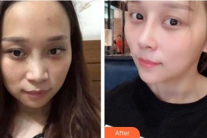 臺州市博愛醫(yī)院整形美容科孫菊妹整形價格表附肋軟骨隆鼻案例展示