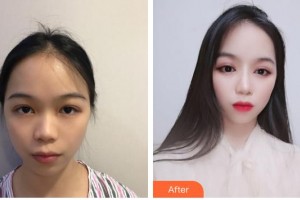 臺州骨傷醫(yī)院整形美容科項攀整形價格表附鼻部綜合案例展示